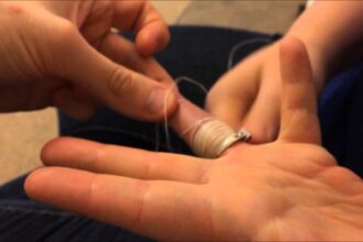 How to Get a Ring Off a Swollen Finger